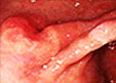 <font size=2px>조기위암</font>