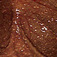 <font size=2px>대장 흑색종</font>