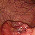 <font size=2px>조기 대장암</font>